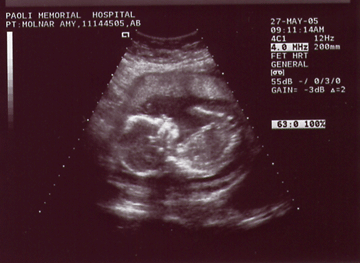 At 20 weeks