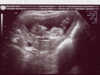 Our second daughter's body (at 12 weeks)