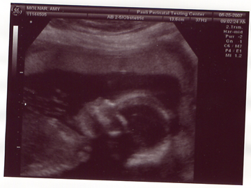 Our second daughter's head (at 20 weeks)